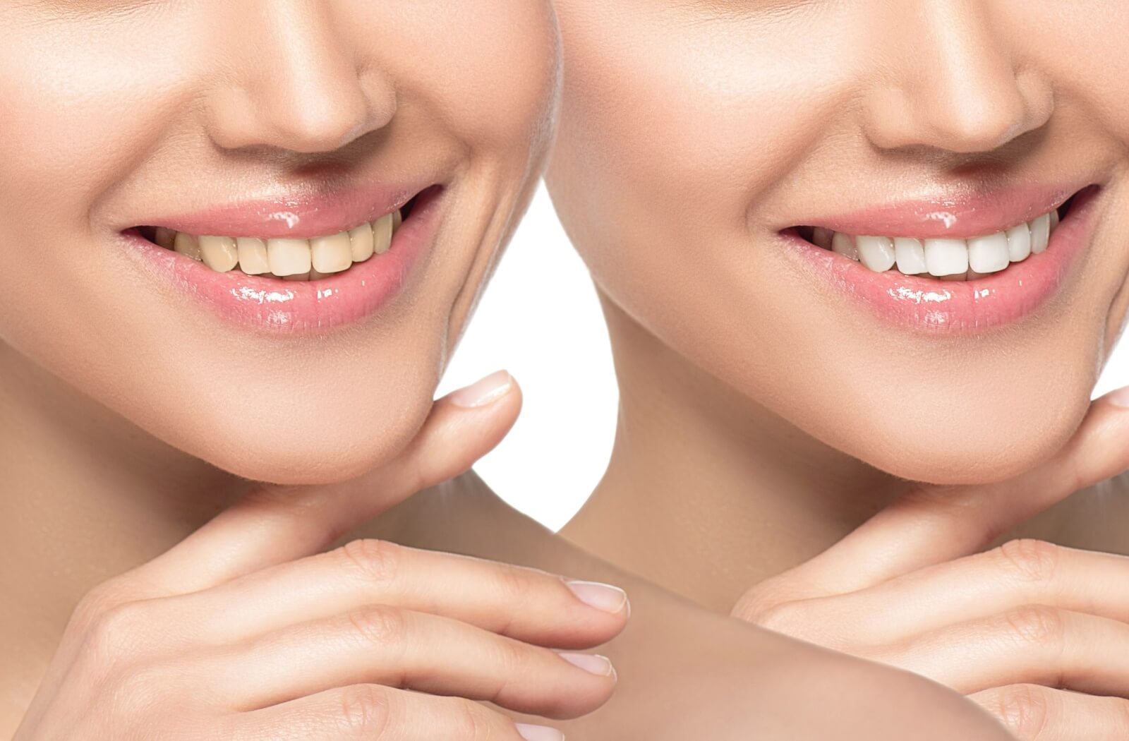 Shown is the difference between healthy yellow teeth and whitened teeth in a side-by-side comparison.